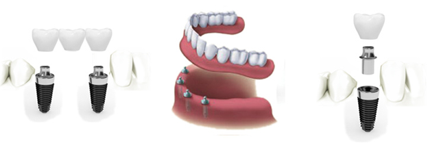 What are Dental Implants and its Advantages?